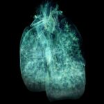 Lung_3